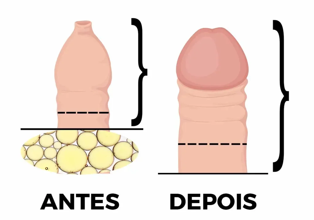 Engrossamento-Peniano-2