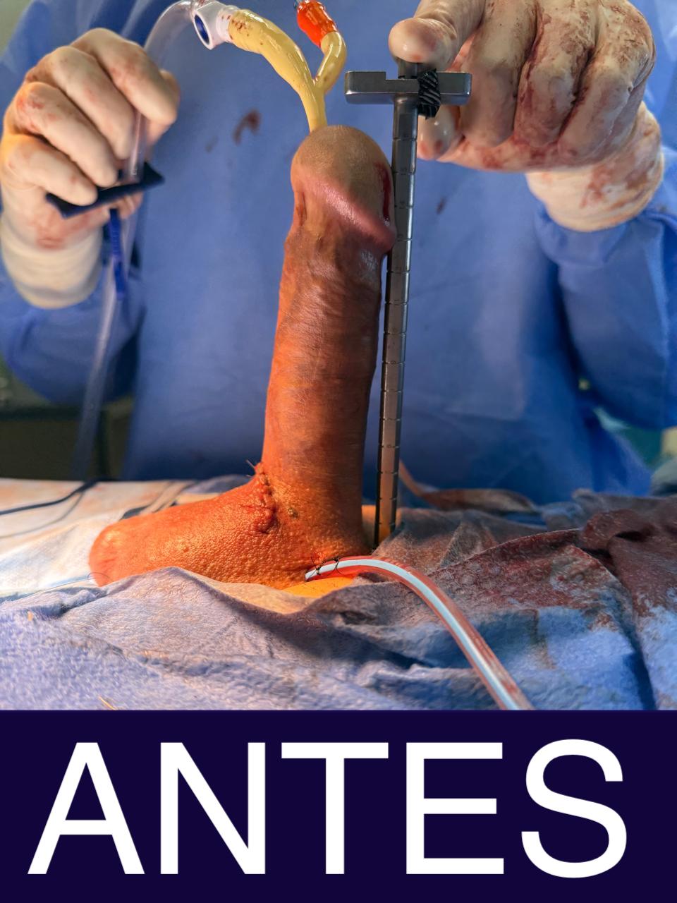 Aumento Peniano - ANTES E DEPOIS
